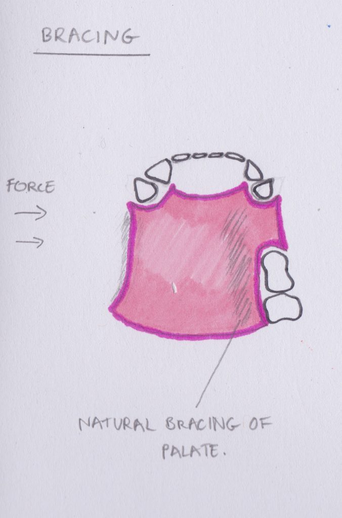RPD - Design - Revise Dental